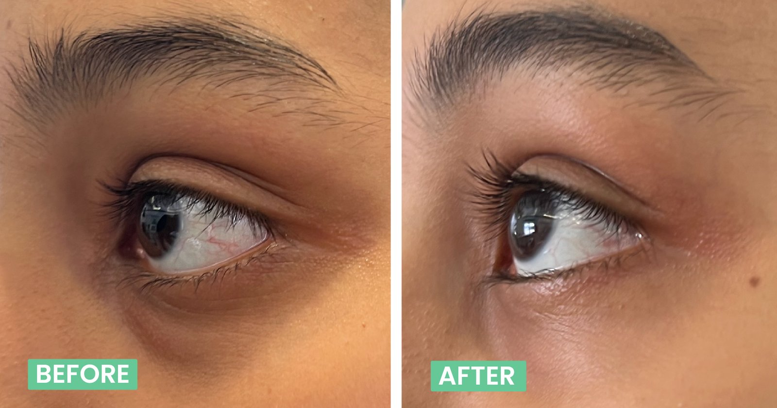 dark circle treatment laser